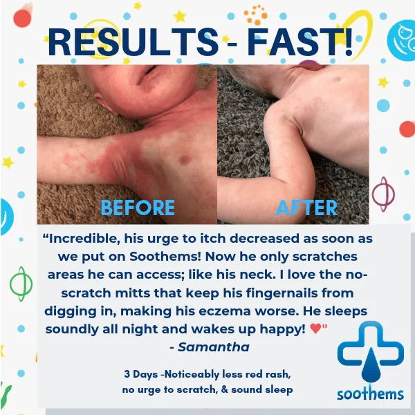 Soothems Eczema Baby Sleepsuit for Wet Wrap Therapy With No-Scratch Mitts | Itch Relief Clothing