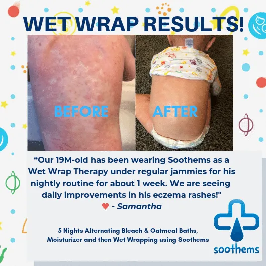 Soothems Eczema Baby Sleepsuit for Wet Wrap Therapy With No-Scratch Mitts | Itch Relief Clothing