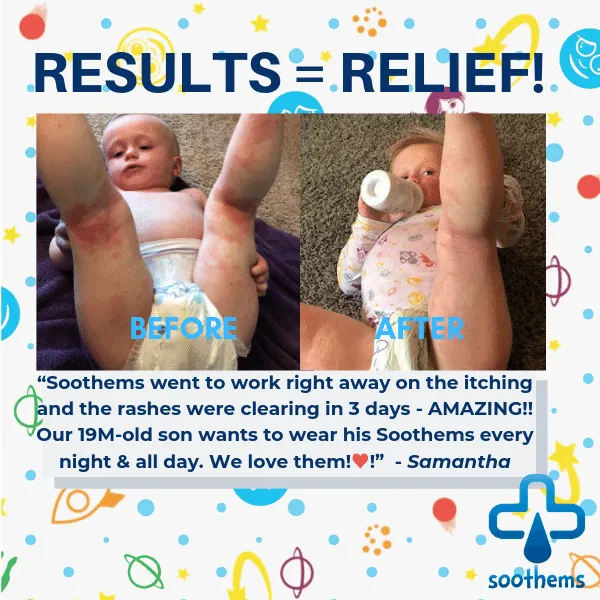 Soothems Eczema Baby Sleepsuit for Wet Wrap Therapy With No-Scratch Mitts | Itch Relief Clothing